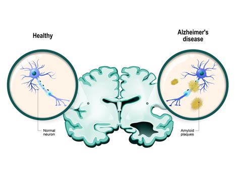 Alzheimer’s disease (AD) - Causes, Symptoms, and Treatment