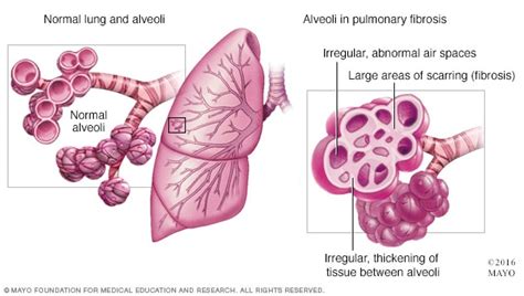 Pulmonary fibrosis - Symptoms and causes - Mayo Clinic