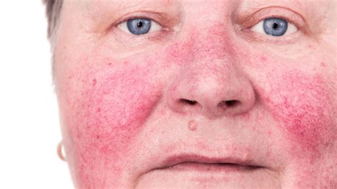 Phymatous Rosacea: Symptoms & Treatments | Gladskin