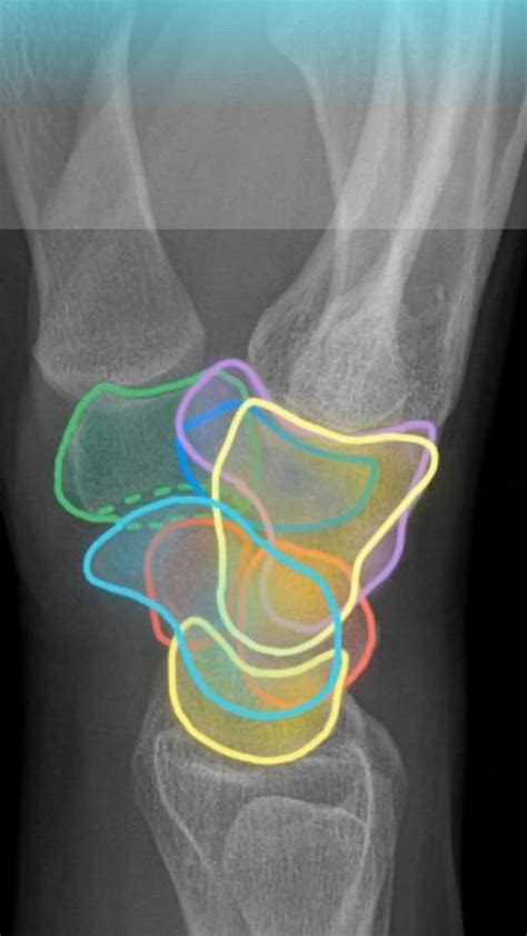 Lateral Wrist Xray Anatomy quiz [Video] | Radiology imaging, Radiology, Radiology student