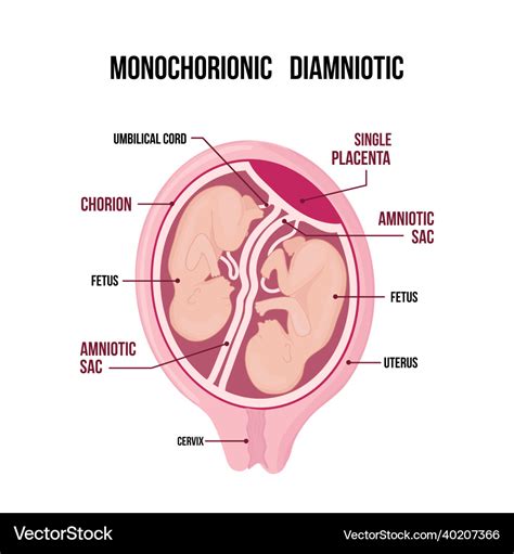 Monochorionic diamniotic twins medical diagram Vector Image