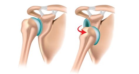 Dislocated Shoulder - Diagnosis, Causes, Treatment & Rehabilitation