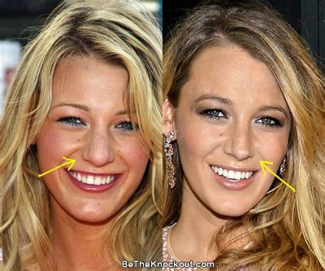 Blake Lively Plastic Surgery Comparison Photos