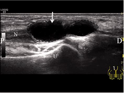 Ultrasound images of the intraneural ganglion of the ulnar nerve at the... | Download Scientific ...