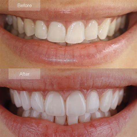 Porcelain Veneers Before and After - The Dental Room