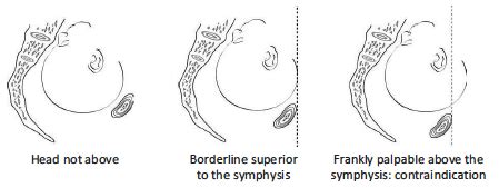 5.7 Symphysiotomy | MSF Medical Guidelines