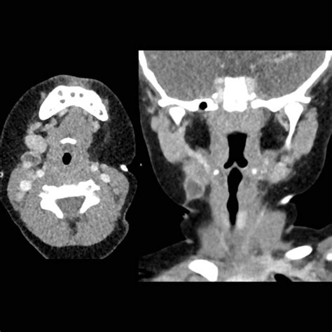 Second Branchial Cleft Cyst | Pediatric Radiology Reference Article ...