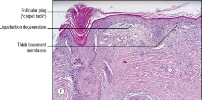 Teledermatology for PG entrance: Discoid lupus erythematosus