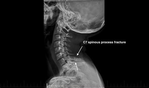 Radiology Review - C7 Spinous Process Fracture | Axis Sports Med