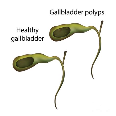 Gallbladder Polyps And Healthy Gallbladder Photograph by Veronika ...