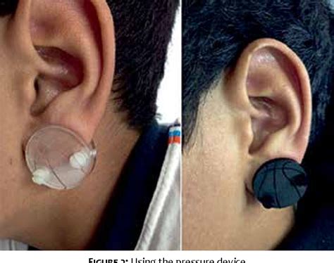 Figure 2 from Effect of combination therapy in the treatment of auricular keloid | Semantic Scholar