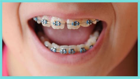 Orthodontic Treatment - Denta Kings