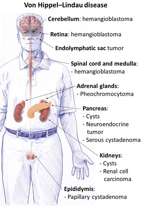 Von Hippel–Lindau disease - Wikiwand