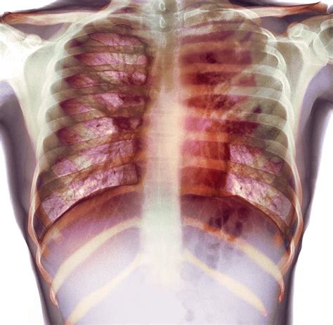 Tuberculosis, X-ray Photograph by Du Cane Medical Imaging Ltd - Fine ...