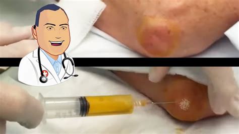 Before and After Elbow Drained - Olecranaon Bursitis Aspirated - YouTube