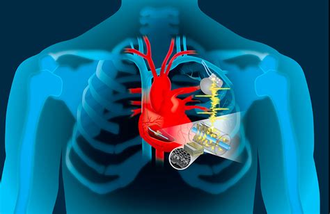 Could this device replace pacemaker batteries? - MassDevice