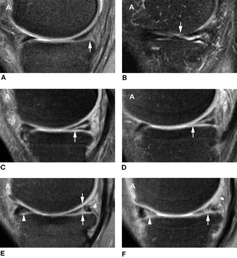 Medial Meniscus Tear Mri