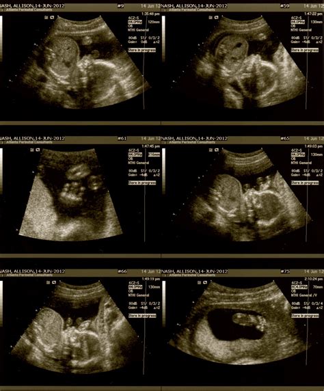 Sweet Baby Nash: 20 Week Anatomy Scan