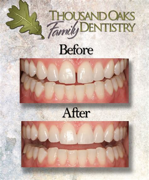 #bonding before and after to close gap between front two teeth #thousandoaksdentist | Cosmetic ...