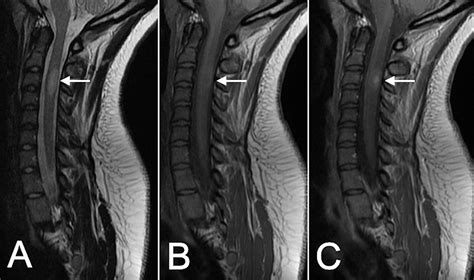 Cervical Spine Ms Lesions On Mri | My XXX Hot Girl