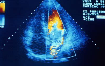 The MUGA scan for diagnosing heart disease