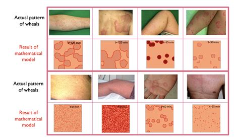 Studying the geometry of a common skin disease | Asia Research News