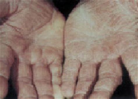 Hand Fungus – Symptoms, Causes, Pictures and Treatment : Health Blog