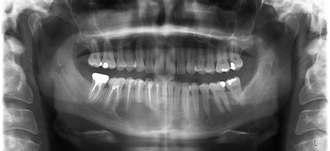 Peripheral Giant Cell Granuloma Radiograph