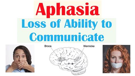 Aphasia | Types (Broca’s, Wernicke’s, Global), Causes, Signs & Symptoms, Diagnosis, Treatment ...