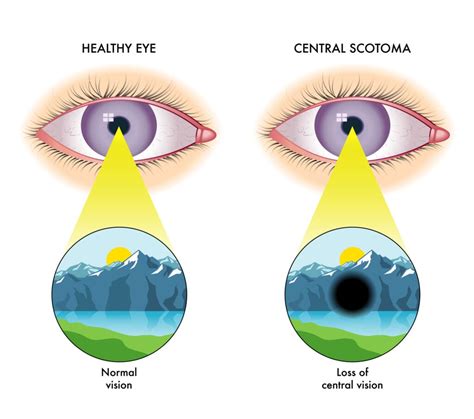 Different Types of Scotoma: Symptoms & Causes