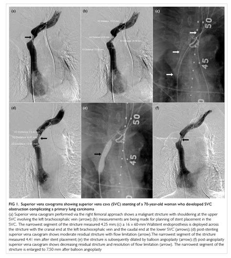 Endovascular stenting in the management of malignant superior vena cava obstruction: comparing ...