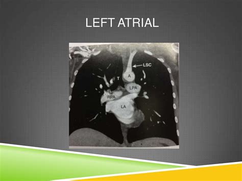 CT ANATOMY OF NORMAL MEDIASTINUM MADE EASY