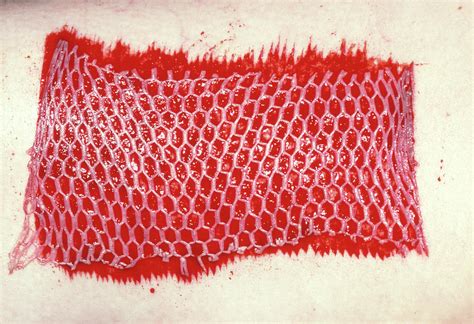 Mesh Skin Graft Attached To Burn Injury Photograph by James Stevenson/science Photo Library