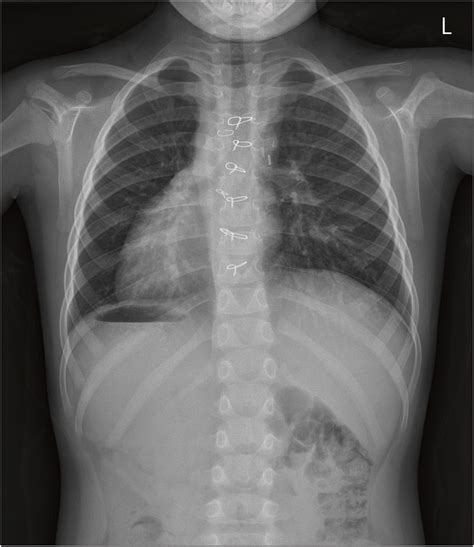 Preoperative chest radiography showing situs inversus totalis with... | Download Scientific Diagram