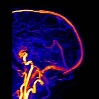 MRI Images - PCA-MRA 3D Brain Venography Colored MIP - MR-TIP.com
