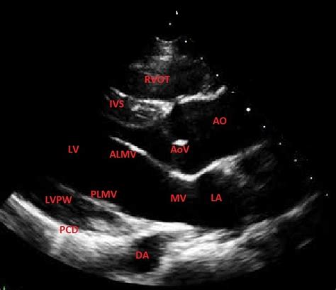 Normal Echocardiogram