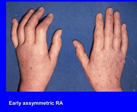 Do You Wake Up in the Morning with Swollen and Stiff Hands? | Steve A. Mora, MD