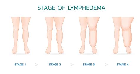 About Lymphedema - Lymphatica Medtech