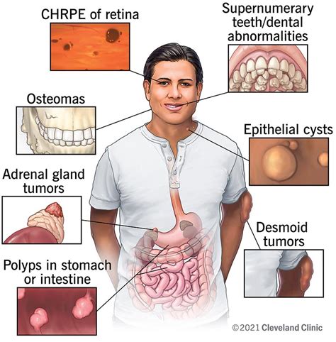 What are the symptoms, causes, and treatment of colon polyps in Pune? | Dr. Samrat Jankar