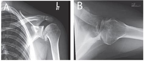 Glenohumeral Arthritis | Musculoskeletal Key