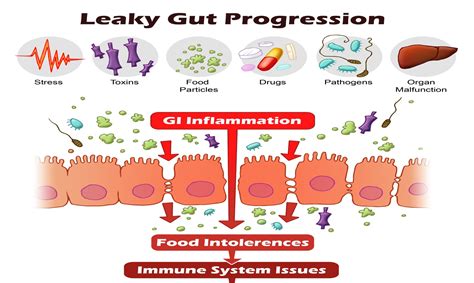 Causes-of-Leaky-Gut-Syndrome-Leaky-Gut-Progression - North Shore ...