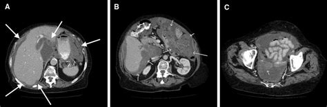 A patient with wide tumor growth. Tumor involvement in the liver hilus ...