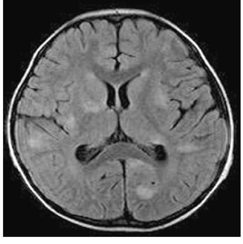 Axial T2-weighted MRI of the patient's brain. Several high intensity ...