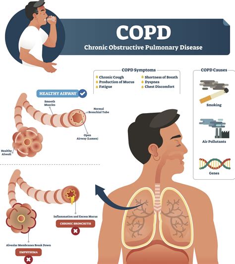 COPD and Covid-19: What to Know - SaferCare Texas