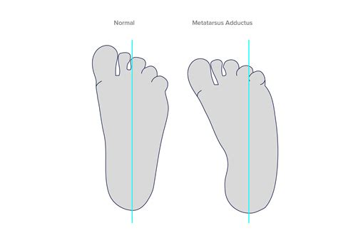 Metatarsus Varus or Adductus – KevinRoot Medical