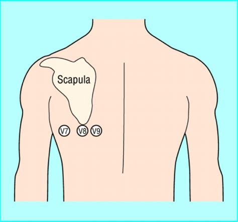 ECG Class - Keeping ECGs Simple: Posterior MI - #ECGclass case 29