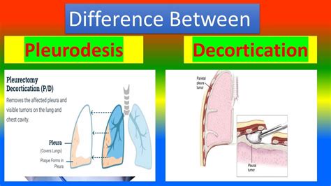 Difference between Pleurodesis and Decortication - YouTube