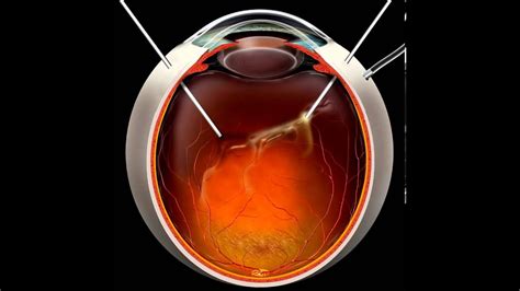 Diabetic retinopathy