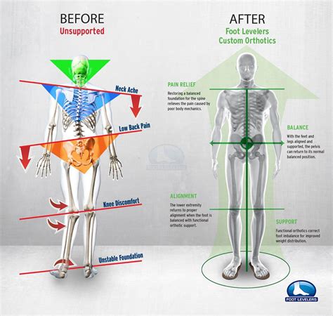 Addressing Functional Scoliosis Through Foot Stabilization | Foot Levelers