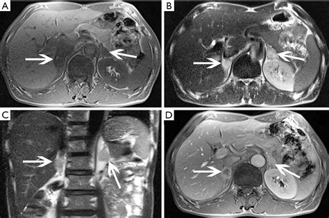 Adrenal Glands MRI - Boulder MRI